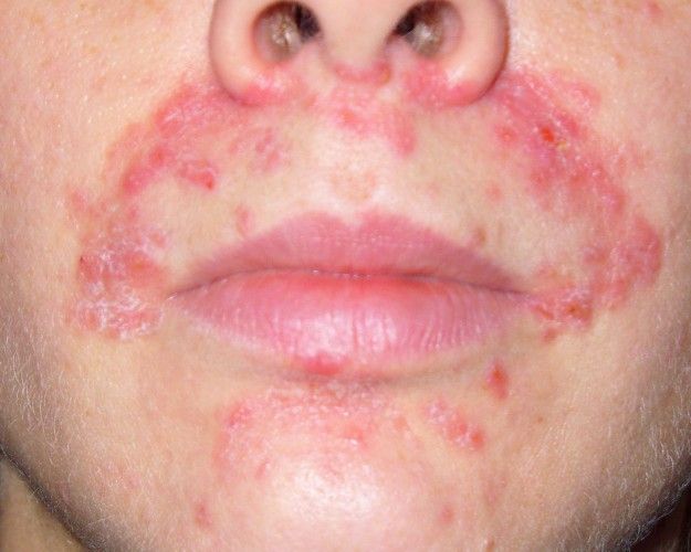 Dermatite Viso Come Riconoscerla Cause E Rimedi