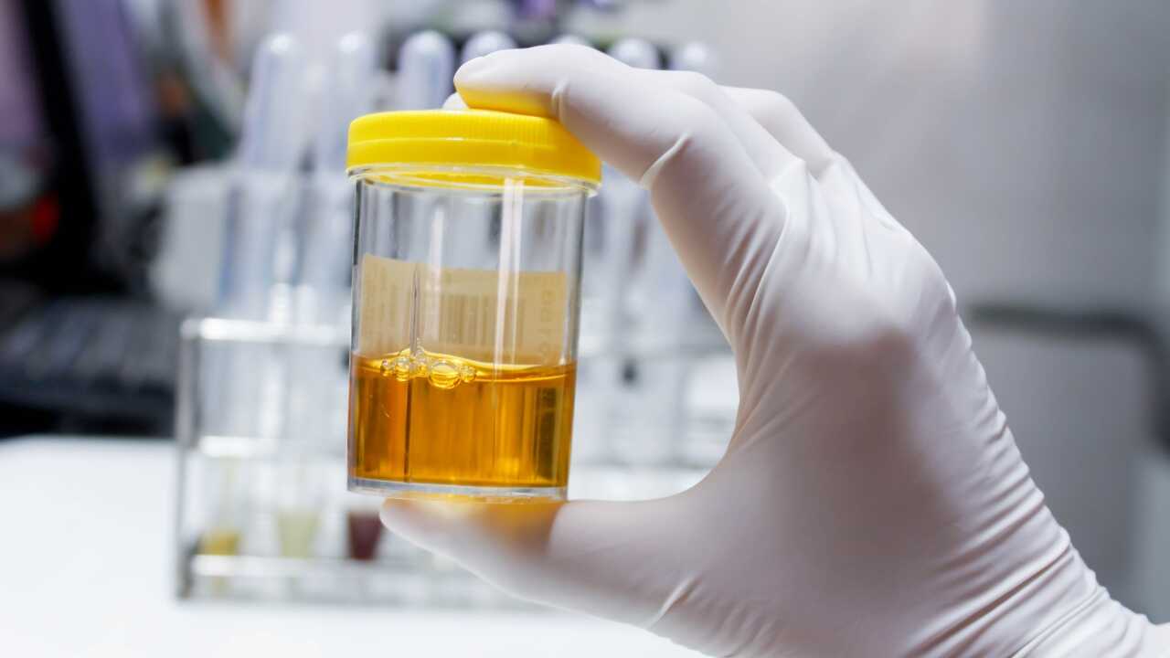 Orange Urine Causes Consequences And Treatment Breaking Latest News