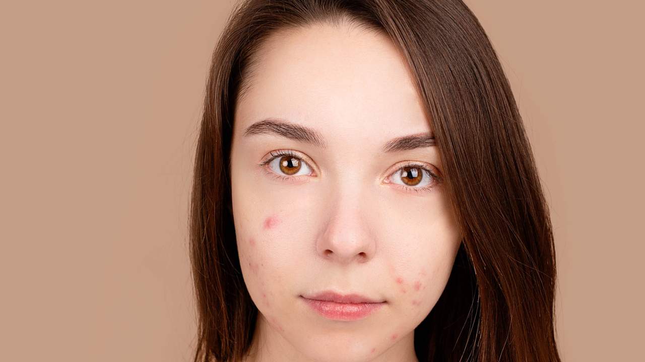 alimenti vitamina A acne