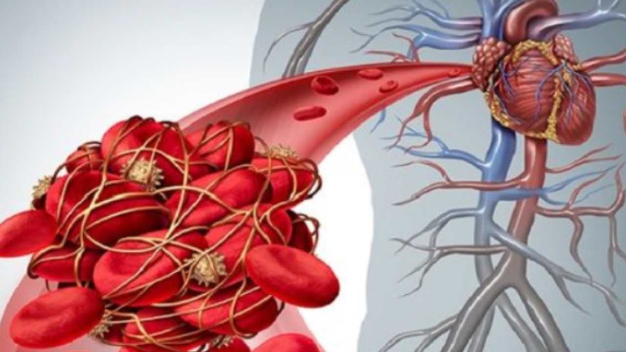 trombosi sintomi posizione coagulo sangue