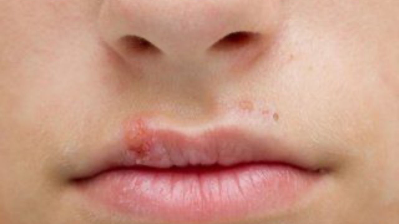 azione causa herpes