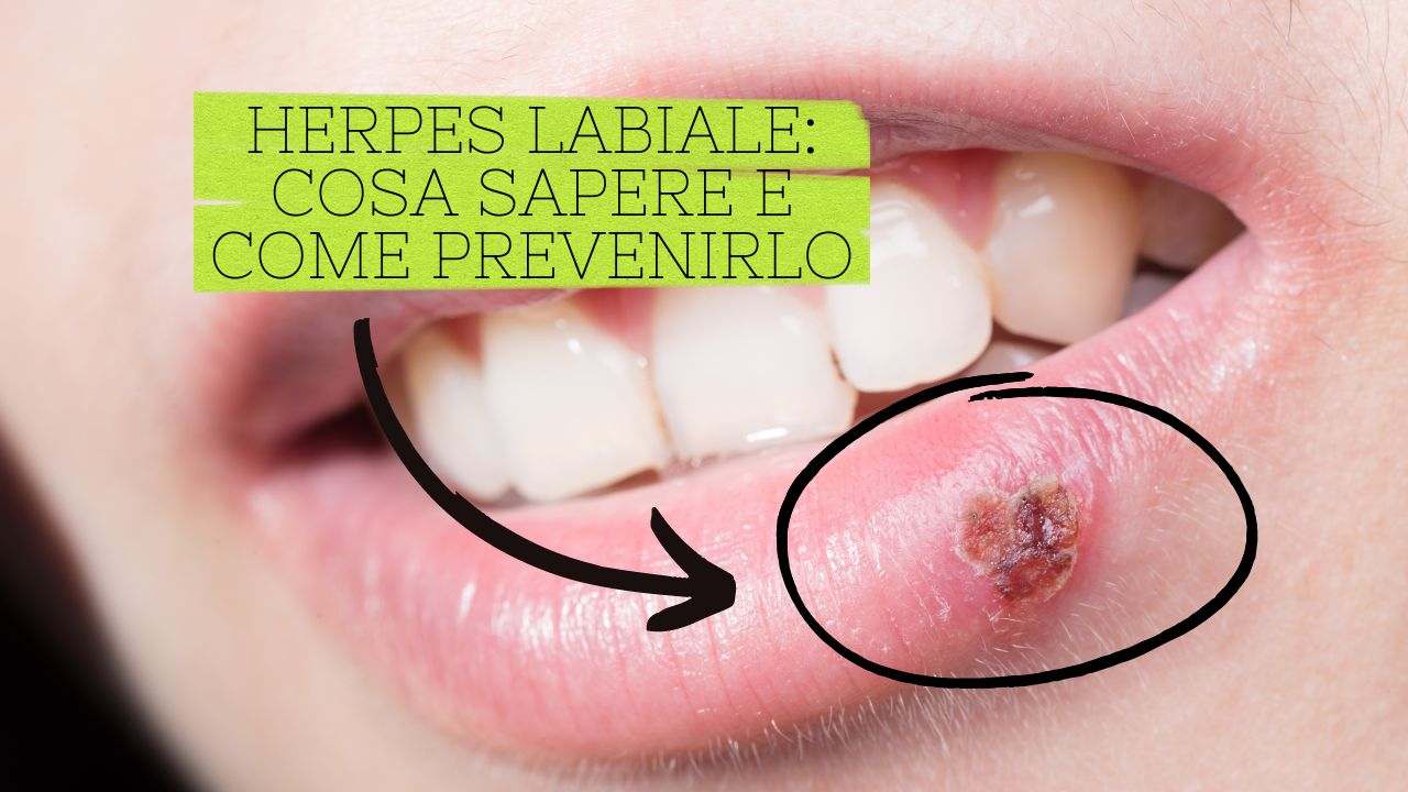 guarire herpes labbra