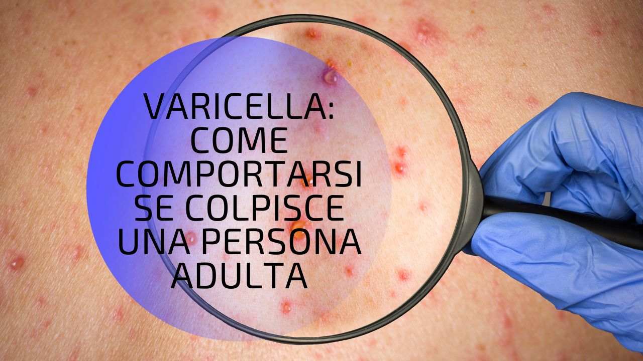 Varicella persone adulte