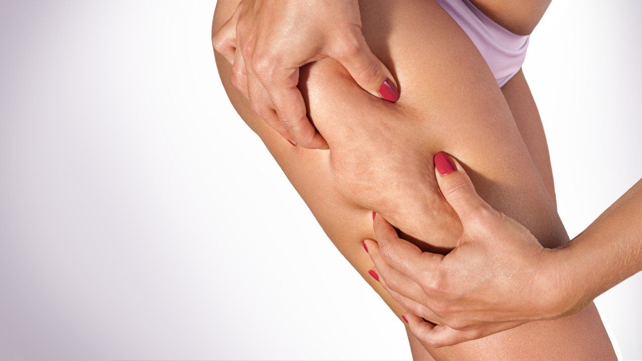 Cellulite cose da sapere per eliminarla