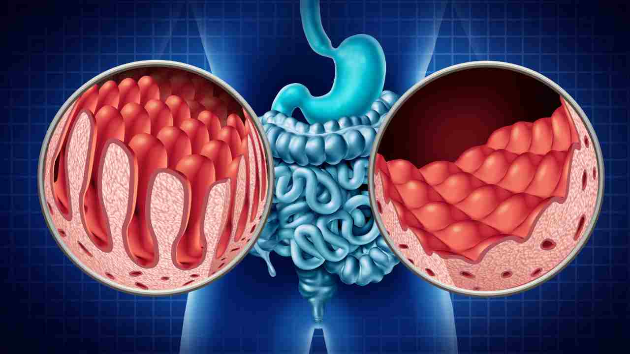 Malattia diverticolare cause e cura